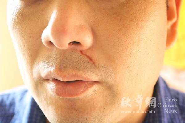 受害者嘴唇上的伤疤